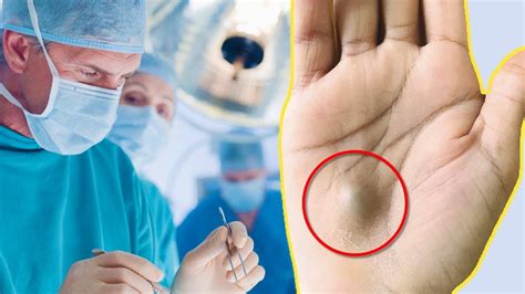 This Guy Found This Strange Lump On His Palm. Then A Scan Revealed The ...