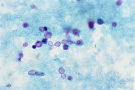 Meningeal Cryptococcosis, CSF, Pap stain | AIDS patient who … | Flickr ...