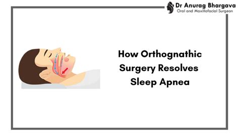 How Orthognathic Surgery Treats Sleep Apnea