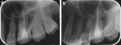 An upper molar with a symptomatic apical periodontitis. a The ...