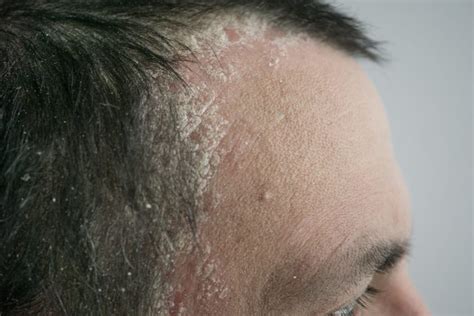 Scalp Psoriasis: What Dermatologists Wish You Knew | The Healthy