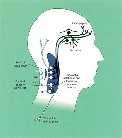 Cervicogenic Headache | Musculoskeletal Key