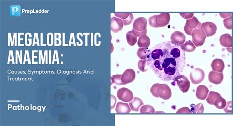 Megaloblastic Anaemia: Causes, Symptoms, Diagnosis and Treatment