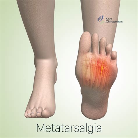 Pin on Metatarsalgia Information