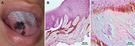 Case #2. Clinicopathological aspects of a congenital melanotic macule ...