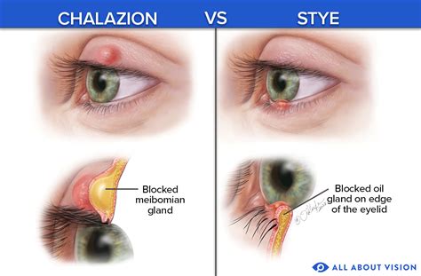 Eyelid Pimple Inside