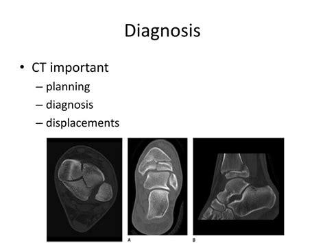 PPT - Triplane Fracture Review PowerPoint Presentation, free download ...