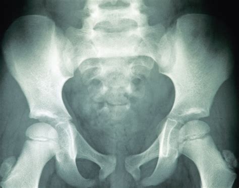 Pelvis X Ray