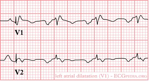 Left atrial enlargement electrocardiogram - wikidoc