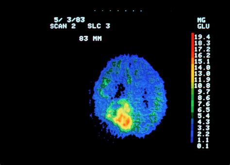 Coloured Pet Scan Of Brain Containing A Tumour Photograph by National ...