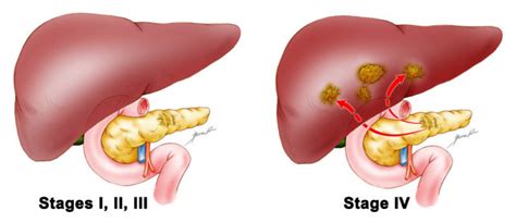 Stage & Grade - Pancreatic Cancer | Johns Hopkins Pathology