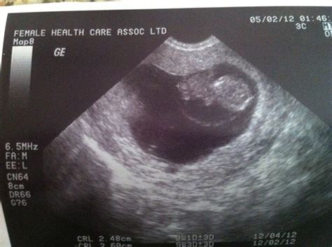 Baby Pulver!!!: 9 weeks & 3 days ultrasound