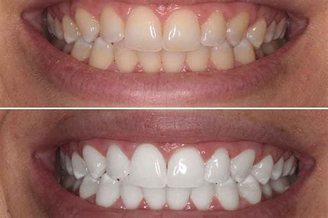 Professional Teeth Whitening in Brooklyn 11229 - Eco Dental NY ...