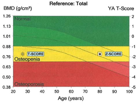 Osteoporosis T Score Chart