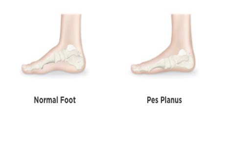 What is Pes Planus? – OrthoFixKids