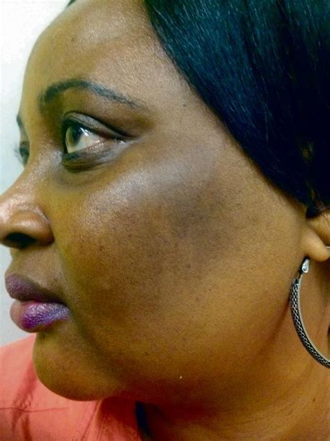 Skin-lightening: Case studies | City Press