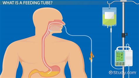 What Is A Feeding Tube? Types Complications Video Lesson, 45% OFF