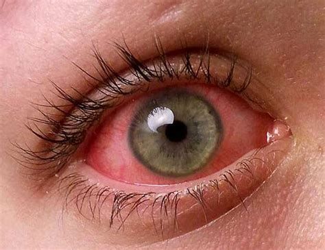 Pink Eye (Conjunctivitis) Symptoms, Treatments And Prevention ...