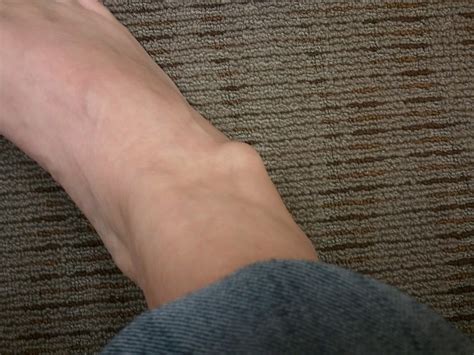 Why Do You Have Lump on Your Ankle? | MD-Health.com