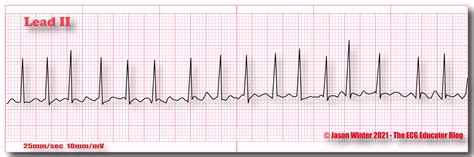 ECG Educator Blog : Atrial Fibrillation (AF)