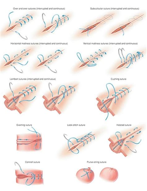 11 Ways to Stitch a Wound — Info You Should Know