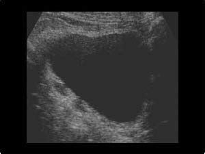 Urinary Tract and male reproductive system | 2.2 Bladder : Case 2.2.3 ...