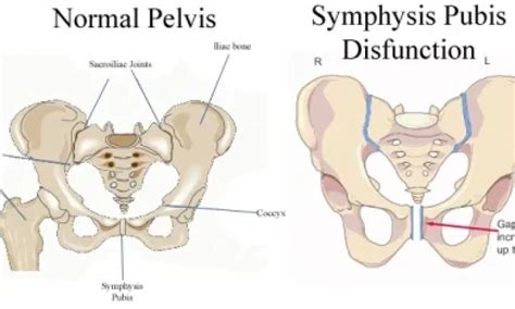 Symphysis Pubis Dysfunction: Causes, Symptoms Treatment, 44% OFF