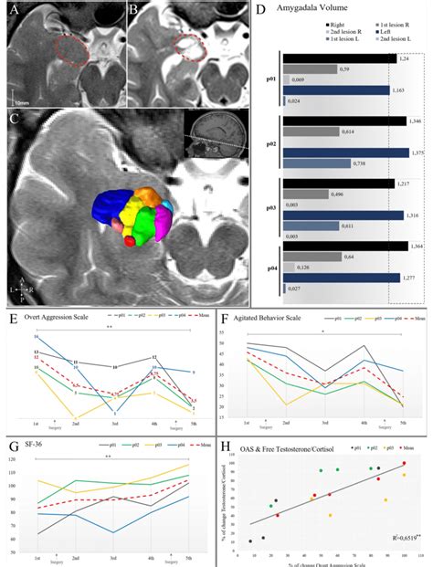 Baseline and follow up evaluations. A. MRI image showing amygdala ...