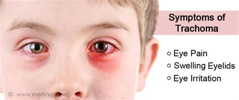 Trachoma - Causes, Symptoms, Complications, Diagnosis, Treatment ...