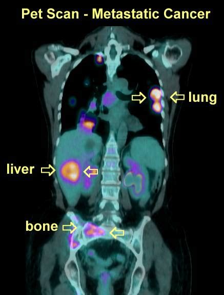 PET Scans in Cancer Cases