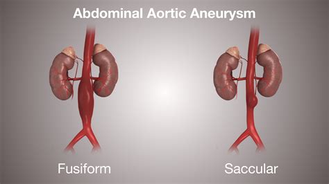 ABDOMINAL AORTIC ANEURYSM: Symptoms, Causes & Treatment - Scientific ...