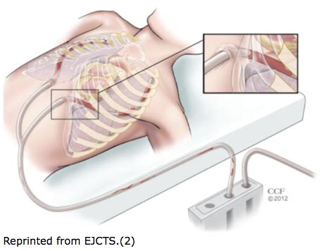 Chest Tube Clogging is Associated with Significantly Higher Rates of A ...