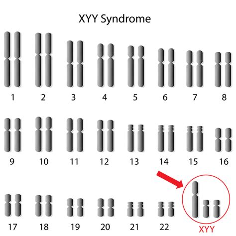 Y Chromosome Karyotype