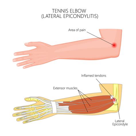 Tennis Elbow Treatment Brisbane - Knead Myotherapy- Get Results