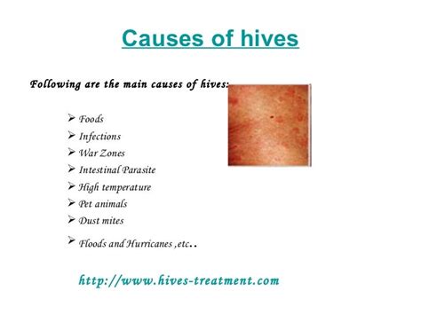 Hives treatment