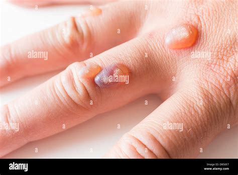 Cryosurgery High Resolution Stock Photography and Images - Alamy