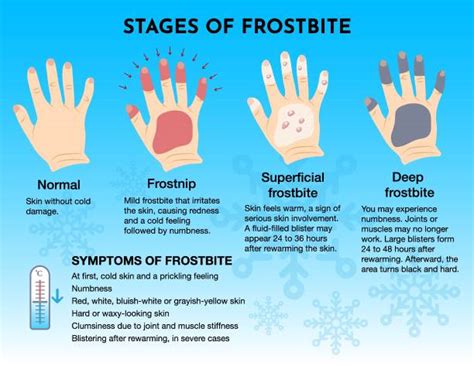 Frostbite Damage Illustrations, Royalty-Free Vector Graphics & Clip Art ...