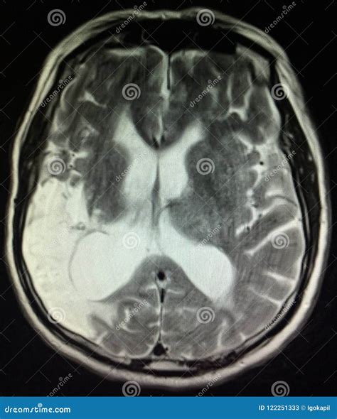 Acute Infarction Brain Mri Examination Stroke Stock Image - Image of ...