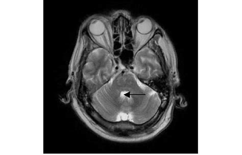 Magnetic resonance imaging (MRI) of patient 1, showing lesions typical ...