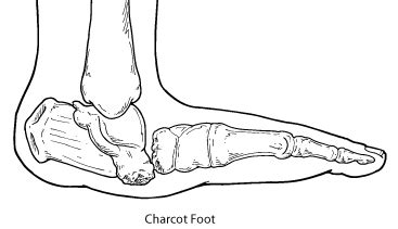 Charcot Arthropathy | Orthopedia Wiki | Fandom powered by Wikia