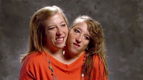 Conjoined twin Abby Hensel is married – NECN