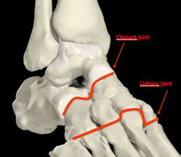 Midfoot Arthritis Treatment | Private Surgeon London | London Foot and ...