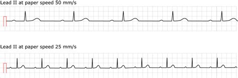 First-degree AV block (AV block I, AV block 1) – ECG learning