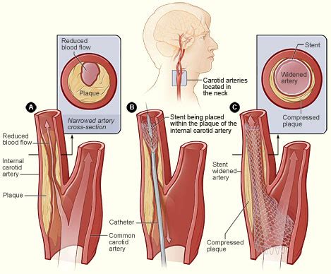 Carotid stenting - Wikipedia