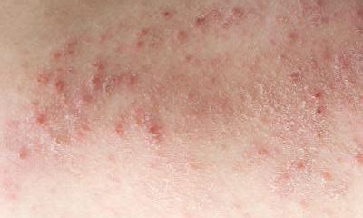 Diabetic Skin Rash Identification