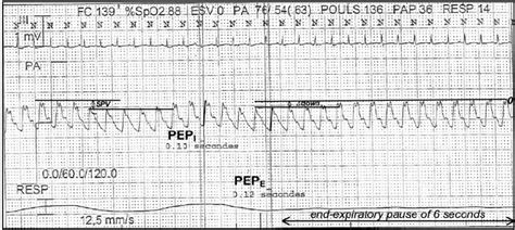 Measurement on positive end-expiratory pressure (PEEP) in hypotensive ...