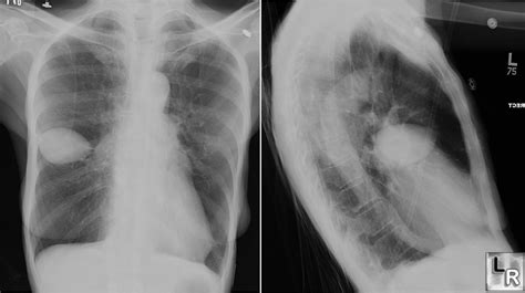 Minor Fissure Lung