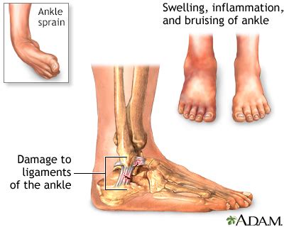 Ankle pain Information | Mount Sinai - New York