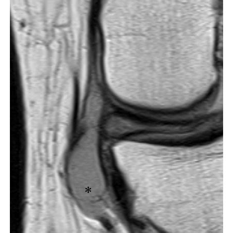 MRI and ultrasound demonstrate the meniscal cyst: (a) coronal ...