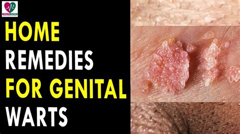 Inspiration 35 of Genital Warts Home Treatment | valleynyc